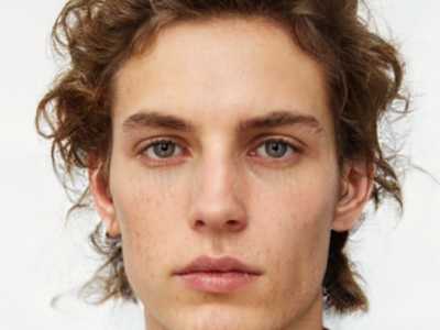 漳州眼科医院牙龈突出矫正的手术效果如何